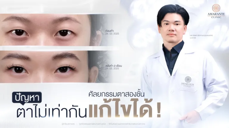 แก้ตาไม่เท่ากันสองข้างด้วยตาสองชั้น