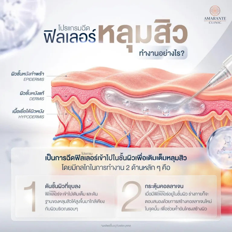 กลไกการฉีดฟิลเลอร์เพื่อรักษาหลุมสิว