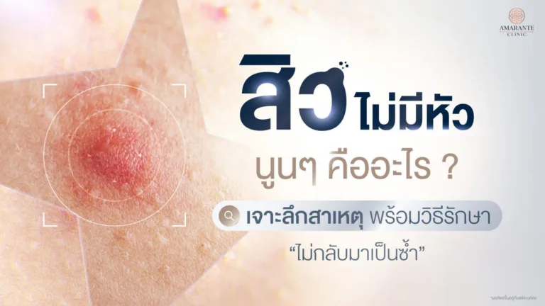 สิวไม่มีหัว นูนๆ คืออะไร รักษาสิวอักเสบไม่มีหัววิธีไหนดี