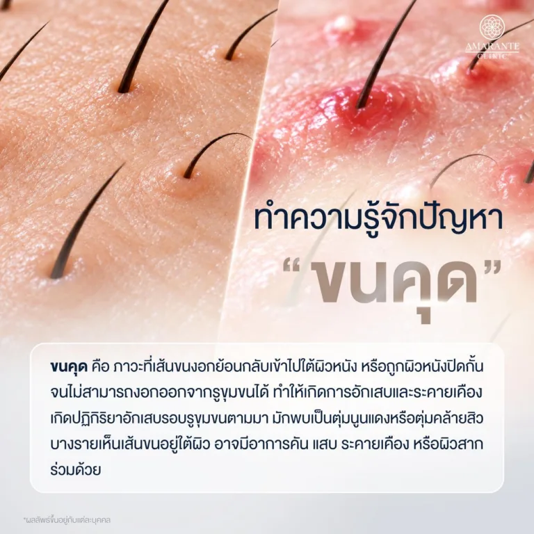 ตัวอย่างขนคุด ขนคุดอักเสบ