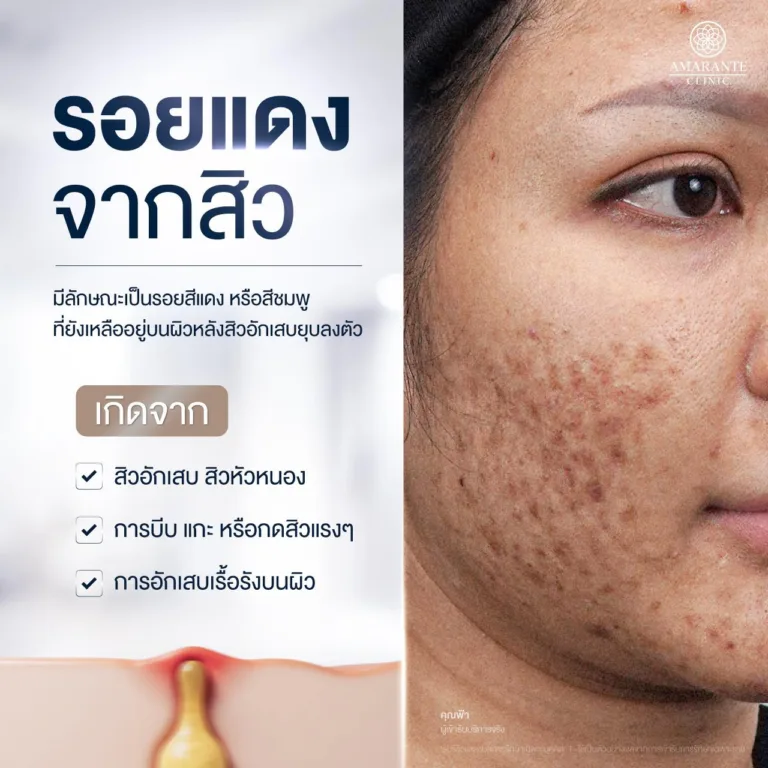 รอยแดงจากสิว คืออะไร เกิดขึ้นได้อย่างไร
