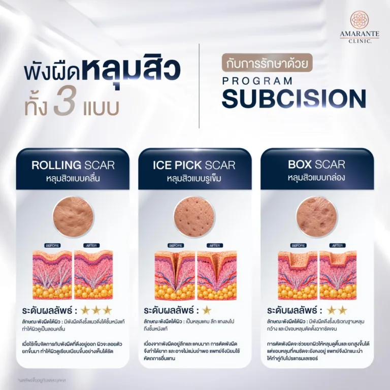 ผังผืด หลุมสิวชนิดต่างๆ