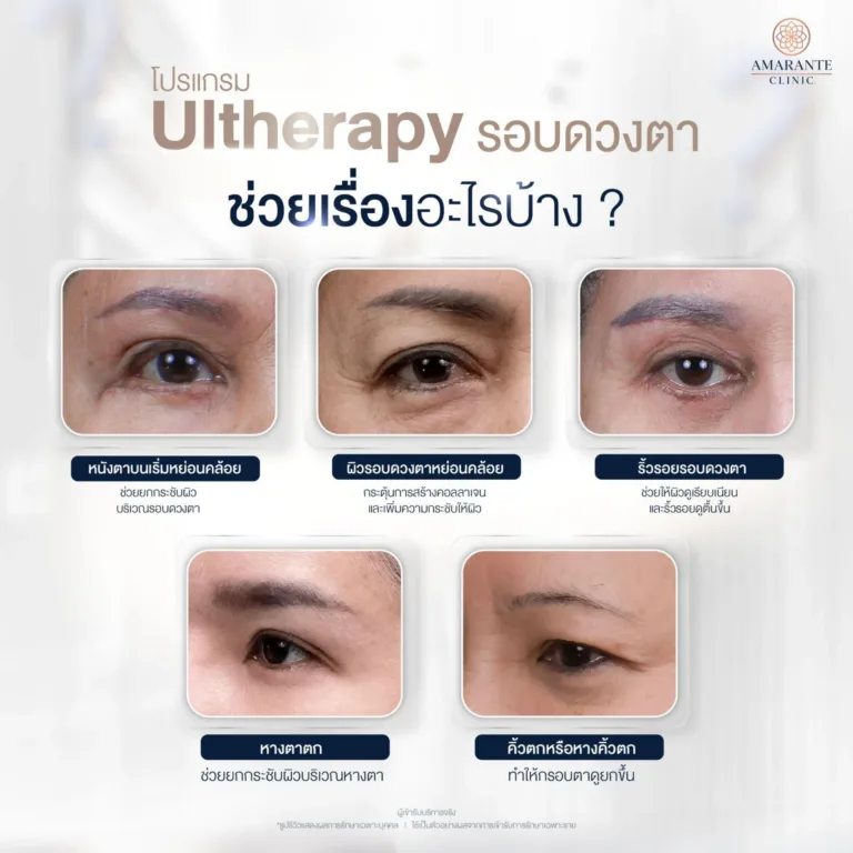 Ultherapy รอบดวงตา ช่วยเรื่องอะไรบ้าง